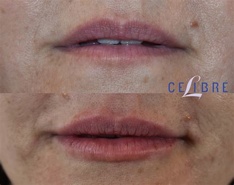 Lip Injections Before And After Juvederm