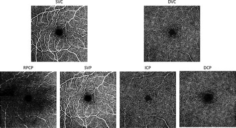 En Face Macular Octa Images Of Vascular Plexuses Identified With Axial