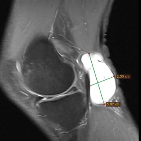 Sagittal T2 Weighted Image With Increased Signal Of The Cyst Lying Just