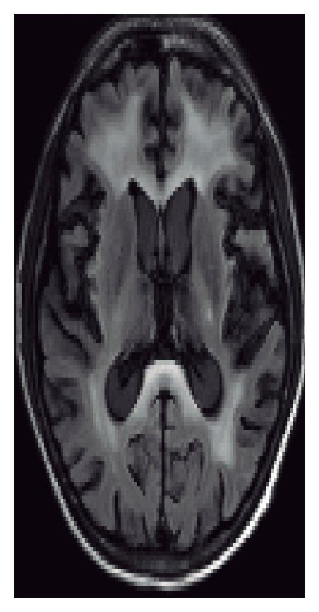 Sequential Mri Of The Brain And Myelin Stain Axial Flair Images Show