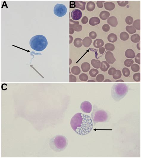 Figure Congenital Trypanosomiasis In Child Born In France To African