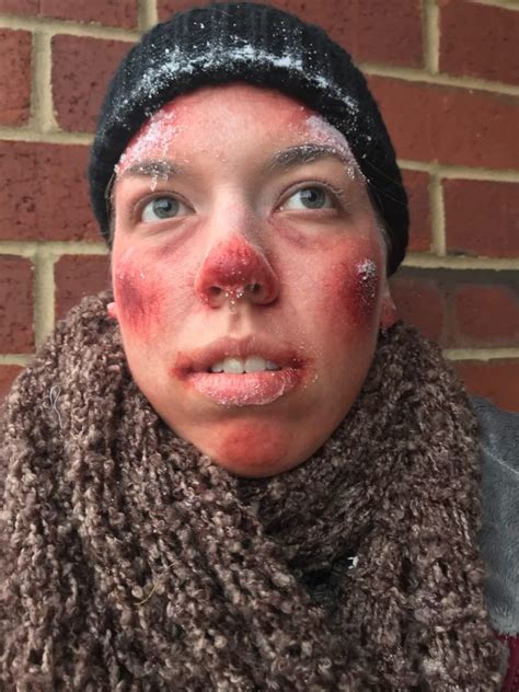 Minor Frostbite Makeup Sfx