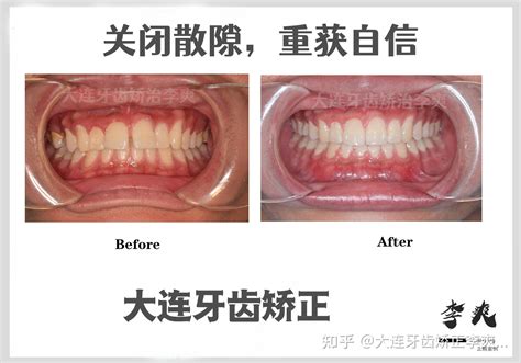 大连牙齿矫正丨门牙缝隙太大是种什么体验？ 知乎