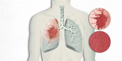 Cáncer de Pulmón Qué es el Cáncer de Pulmón PortalCLÍNIC