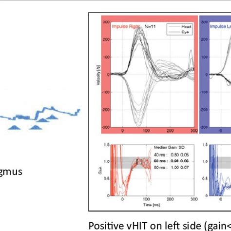 Acute Vestibular Neuritis Findings Download Scientific Diagram