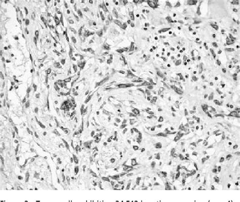 Figure 2 From Low Grade Fibromatosis Like Spindle Cell Metaplastic Carcinoma A Basal Like Tumor