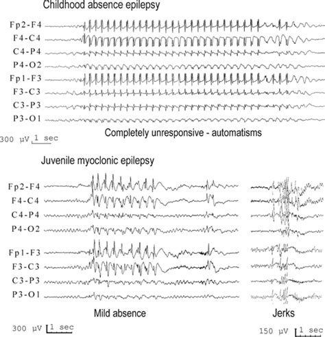 Tonic Clonic Seizure Eeg