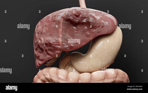 Cancro Del Fegato Dell Organo Digestivo Epatite Cirrosi Tumore Maligno