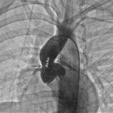 -Confirmation of supravalvular aortic stenosis at angiography ...