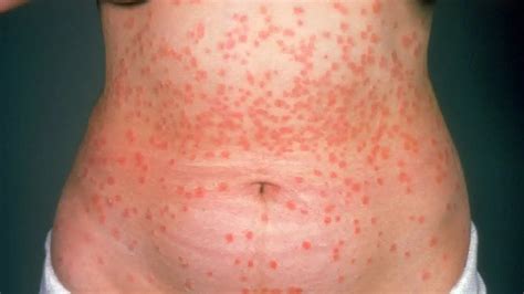 Understanding Guttate Psoriasis