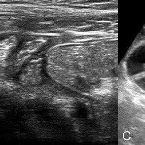 sonographic sign  bowel obstruction  visibility  valvulae