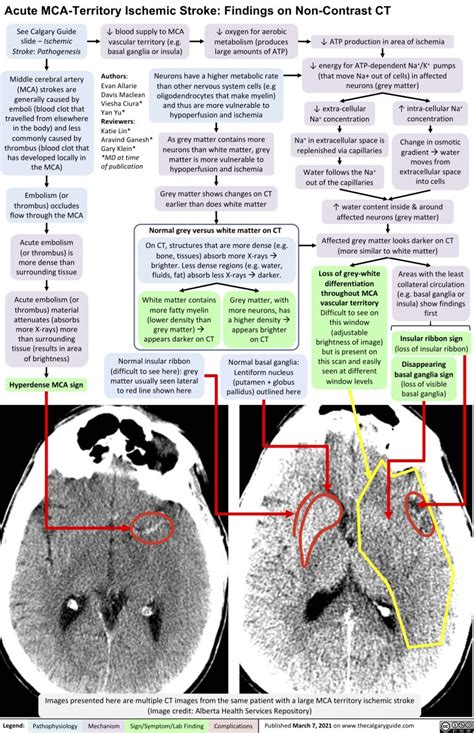 Acute MCA-Territory Ischemic Stroke: Findings on Non-Contrast CT | Calgary Guide