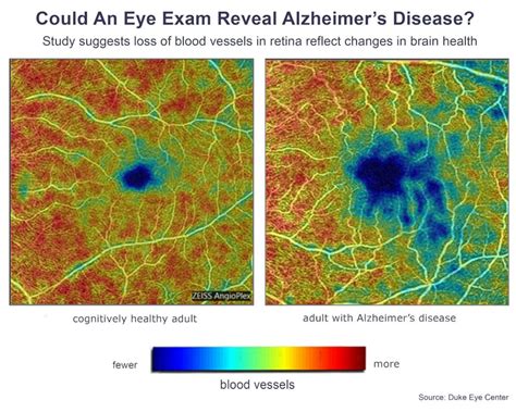 New Study Shows Eye Scan Can Reveal Changes Associated With Alzheimers