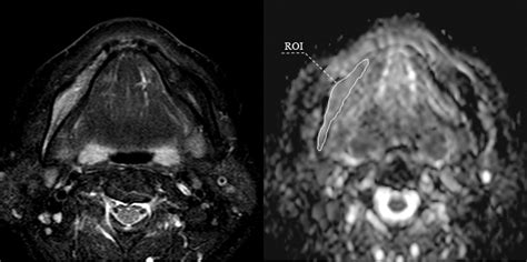 Figure 1 From Diagnostic Efficacy Of Diffusion Weighted Imaging In Distinguishing Chronic