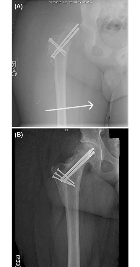 Case 6 16 Year Old Male With Severe Right Hip Slip A Right Hip