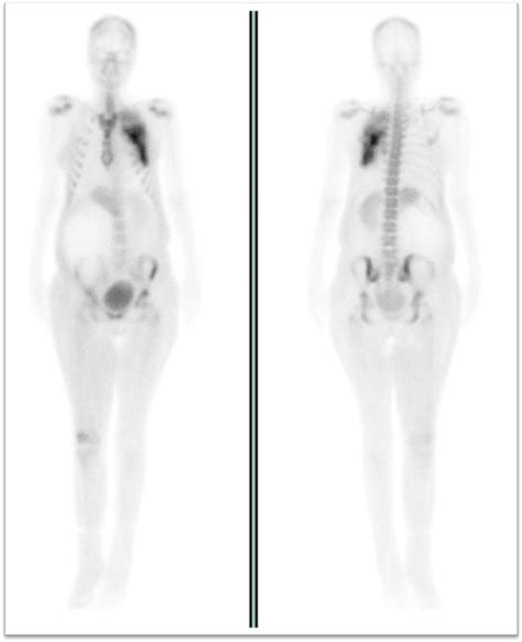 Bone Scintigraphy Demonstrates Tc M Methylene Diphosphonate Mdp