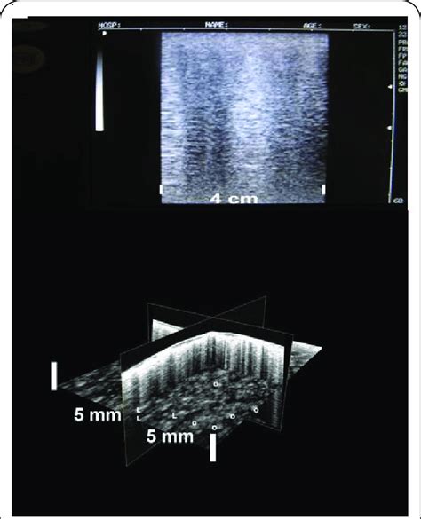 Comparison Of A 2D Sonogram Upper Panel With A 3D Sonogram Lower