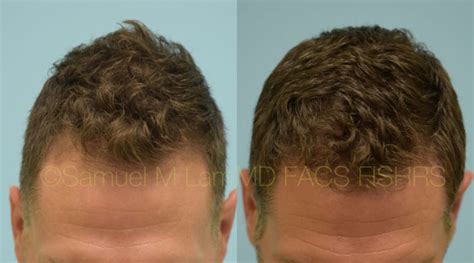 Dallas Finasteride and Minoxidil Before and After Photos - Plano ...