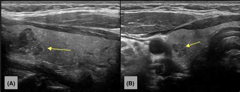 A Long‐axis Ultrasound Image Of The Right Thyroid Lobe Demonstrates A