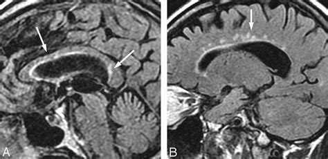 Lyme Neuroborreliosis Manifestations Of A Rapidly Emerging Zoonosis