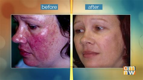 A35b4b17 7e30 4477 B3a8 A23e7264b470 Large16x9 Rosacea Png