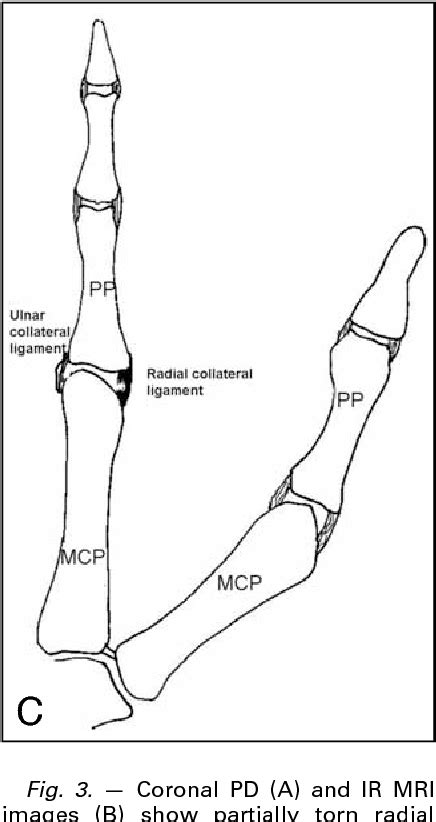 Figure 3 From Imaging In Index Finger Radial Collateral Ligament Injury