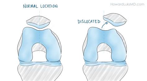 The Dislocated Patella or Kneecap: It Is More Common Than You Think