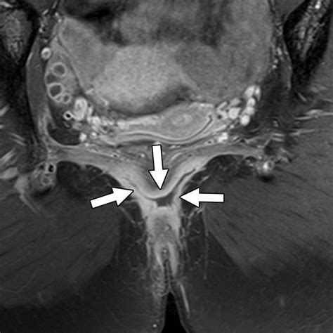 Perianal Imaging In Crohn Disease Current Status With A Focus On Mri From The Ajr Special