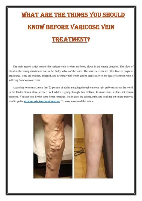 What Are The Things You Should Know Before Varicose Vein Treatment By