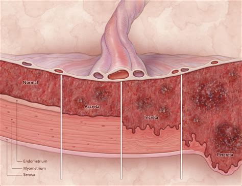 Placenta Acreta Increta E Percreta Retoedu