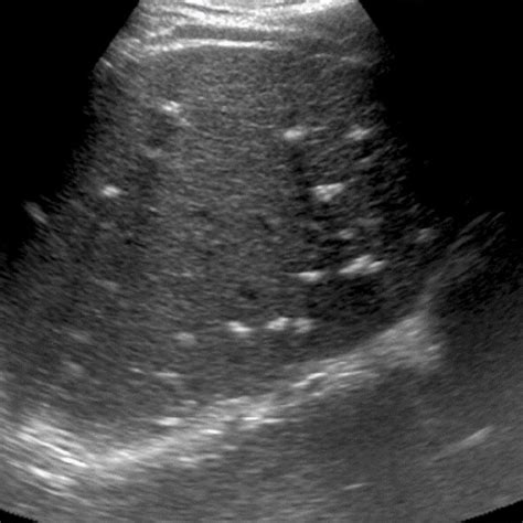 Unenhanced CT scan showing multiple liver calcifications. | Download ...