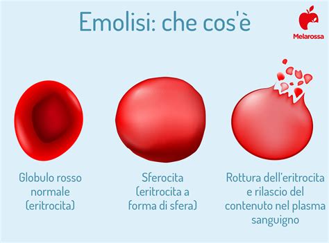 Anemia Emolitica Che Cos Tipi Sintomi Cause Diagnosi E Cure