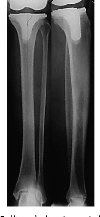 Figure From Alignment Of The Tibial Component In Total Knee