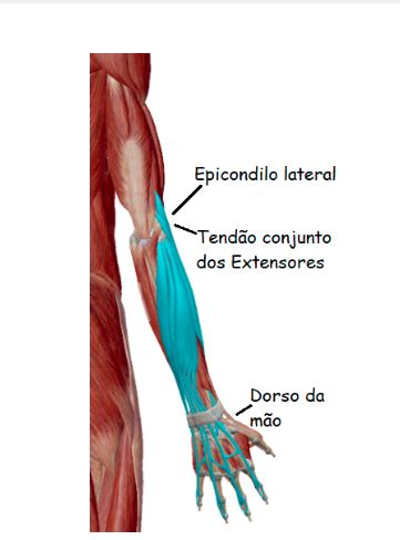 Sintomas De Epicondilite Lateral Do Cotovelo