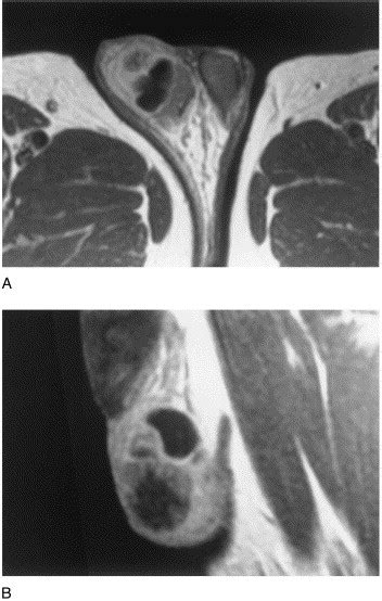 Mixed Tumor Of Paratesticular Rhabdomyosarcoma And An Adenomatoid Tumor