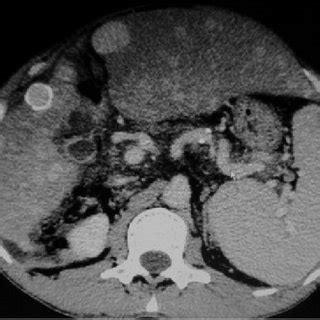 Contrast Enhanced Computed Tomography Scan Showing Hypervascular