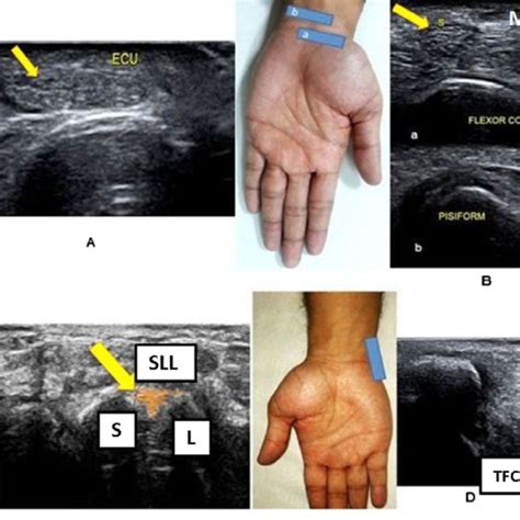 Ultrasound Of The Dorsal Aspect Of The Wrist Demonstrating Extensor