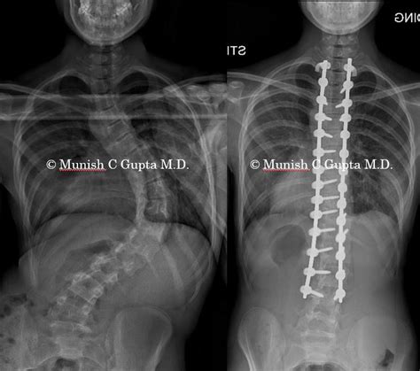 Adolescent Idiopathic Scoliosis Female Munish C Gupta M D