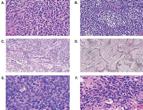 Medulloblastoma Histology