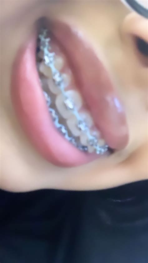 Braces Teeth Colors Cute Braces Colors Teeth Braces Light Blue Braces Pink Braces Silver