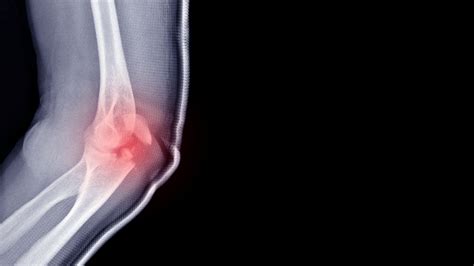 adult elbow fractures physioflow pt physical therapy vancouver wa