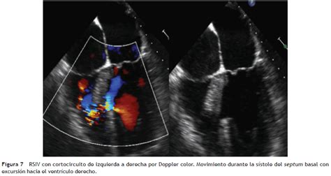 Ecocardiografía en infarto agudo del miocardio