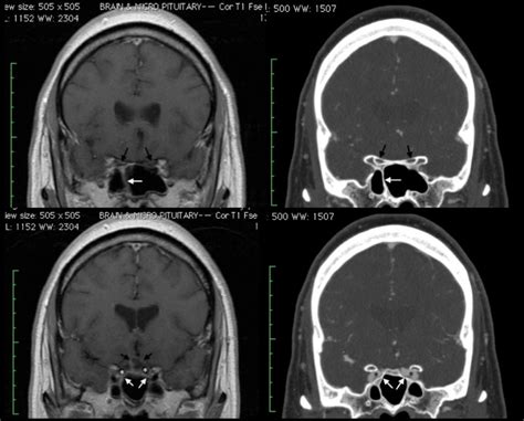 Computerized Tomography Ct Angiography Cta New Jersey Brain And Spine