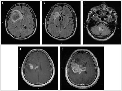 Low Grade Gliomas Continuum Lifelong Learning In Neurology