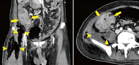 Abdominal Computed Tomography Ct Revealed Ascending Colon Tumor