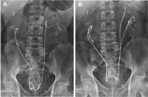 Appearance Of Ureteral Stents On X Ray A Double Pigt Open I