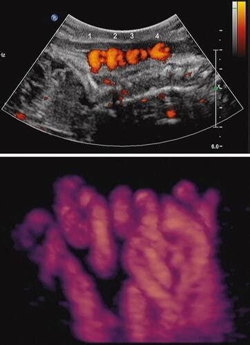 Full Article Current Perspectives Of Prenatal Sonographic Diagnosis