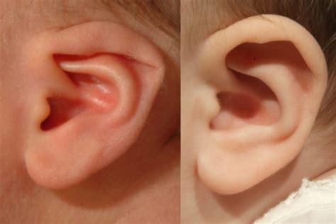 Folded Ear in Newborns: Treatment Options | Los Angeles ENT Doctors ENT ...