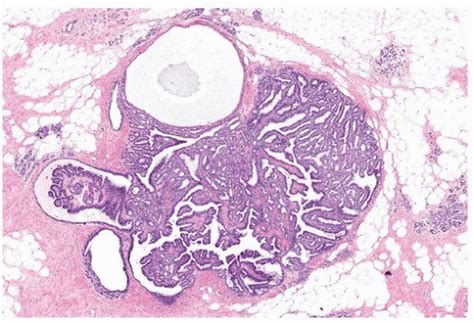 Fibroepithelial Neoplasms Basicmedical Key