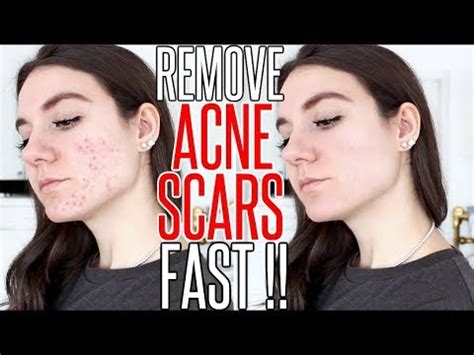 How To Get Rid Of Acne Scars Overnight Youtube